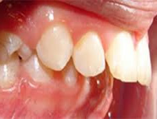 TMJ Specialist In Delhi